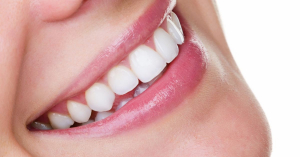 Angel Aligners for a winning smile